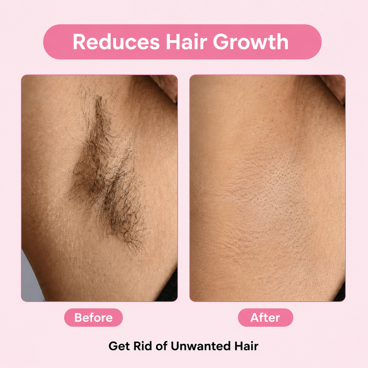 Cyperus Rotundus Oil for Hair Reduction